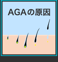 AGAの原因